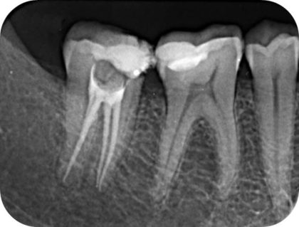 Lečenje korena zuba